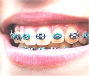 Types of Braces