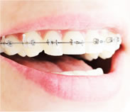 Types of Braces