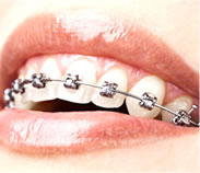 Types of Braces